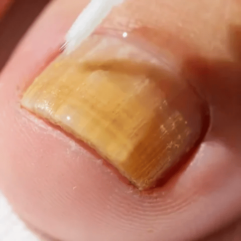 Antifungal Serum Pen